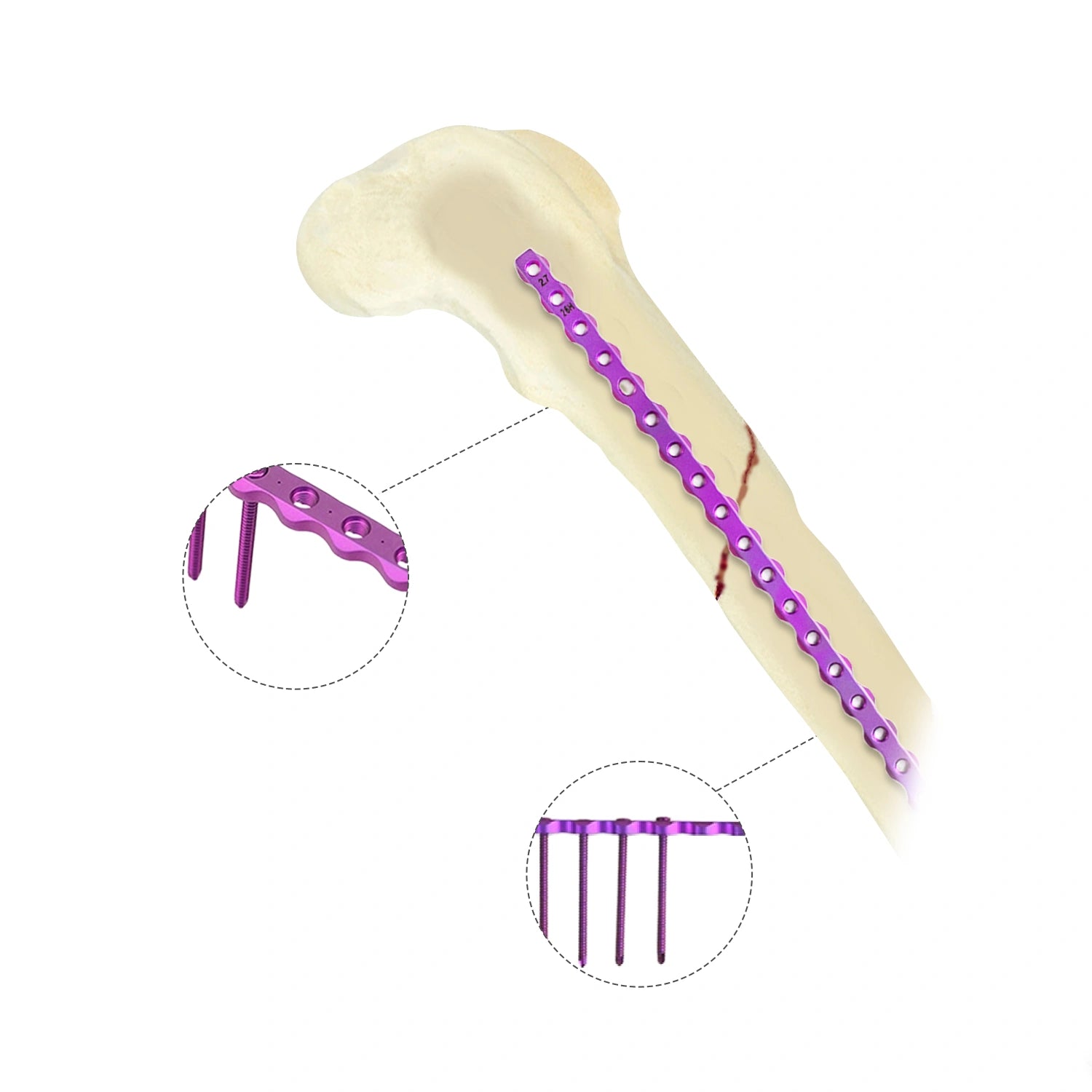 Veterinary 2.7mm AO Reconstruction Locking Plate Premium Ortho Implant - xcvet.com