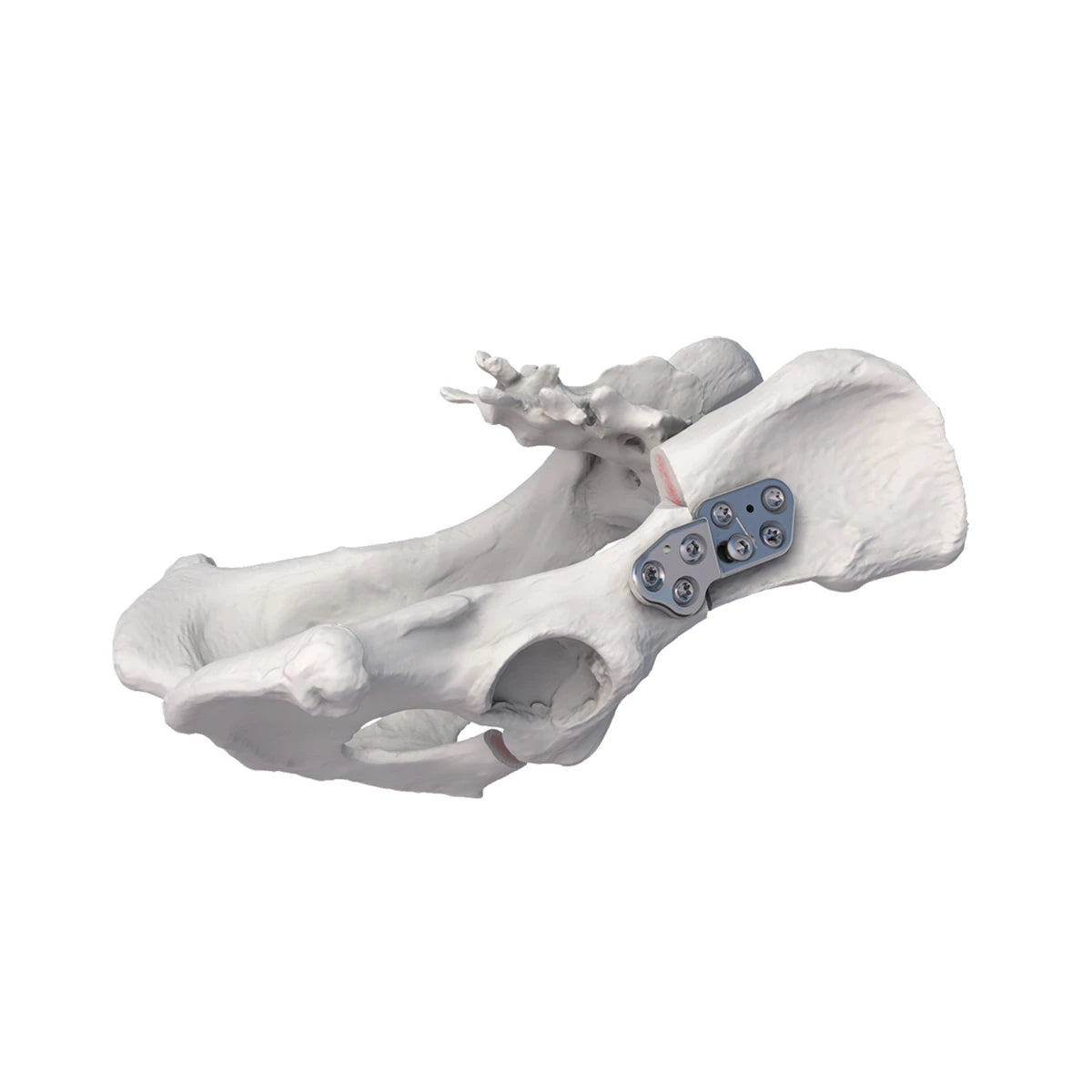 3.5mm Titanium AO-Compatible DPO Locking Plate for Double Pelvic Osteotomy in Medium & Large Dogs - xcvet.com