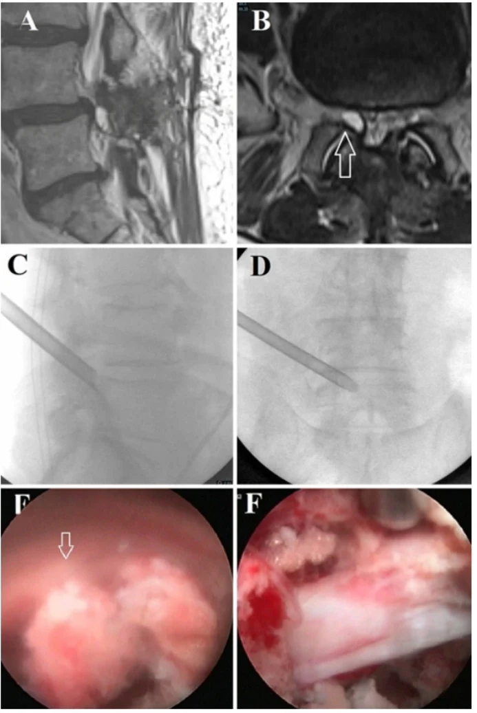 Lumbar Facet Joint Cyst With L5 Nerve Root Compression: Endoscopic Decompression Case Review
