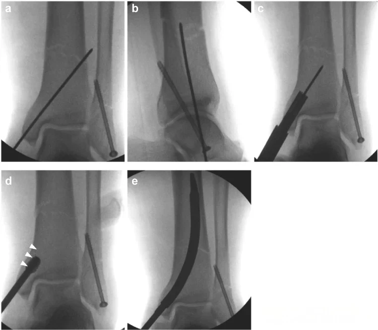 Case Study: Distal Tibia Fracture Retrograde IM Nailing vs Plate Fixation