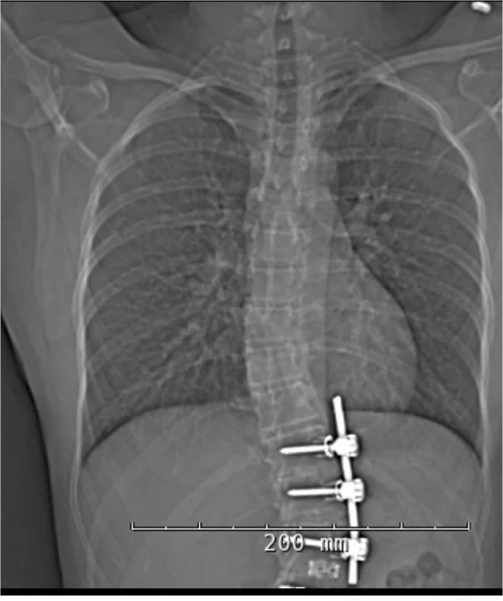 Case Study: Managing Severe Cephalad Migration of Spinal Fusion Rod into The Thoracic Cavity Via Zero-Tolerance Fixation