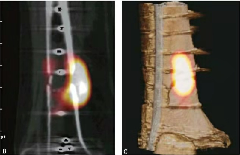 Fracture Healing Assessment in Orthopedic Fixation Cases