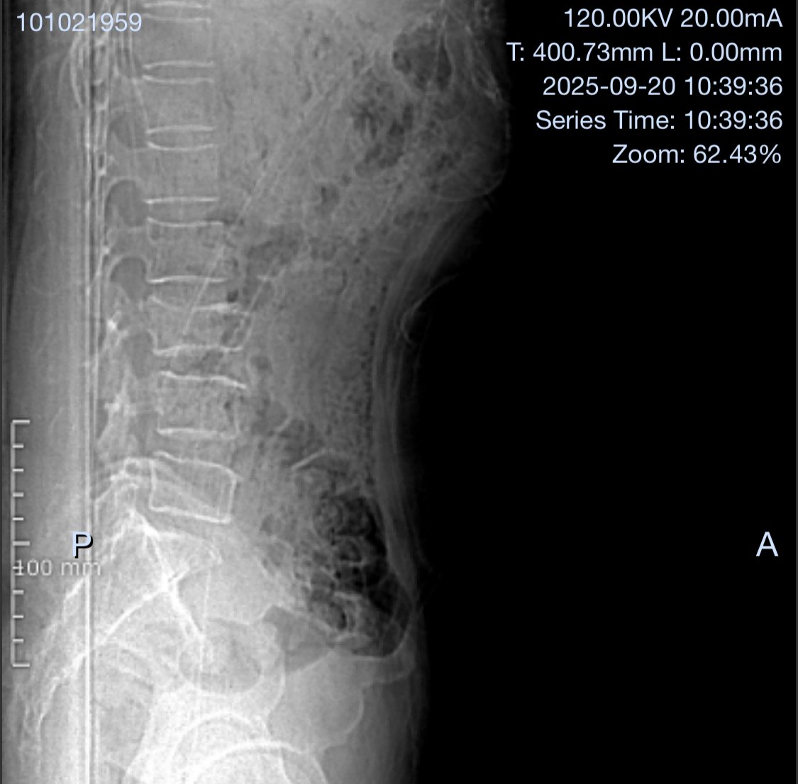Case Study: MIS Cement Screw for L3 Compression Fracture