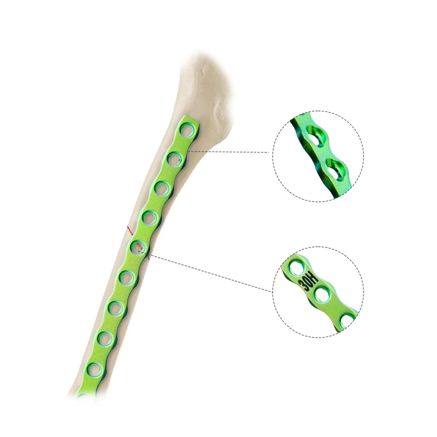 1.6mm Titanium ALPS Bone Plate for Veterinary Pets Surgical Fracture Fixation - xcvet.com