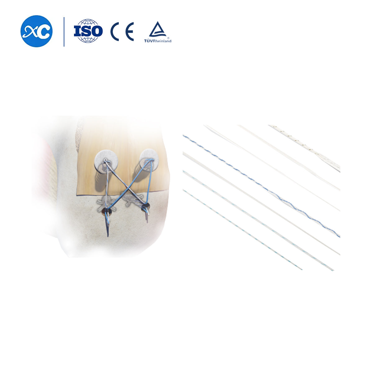 Non-absorbable Medical Suture for Orthopedic Surgery