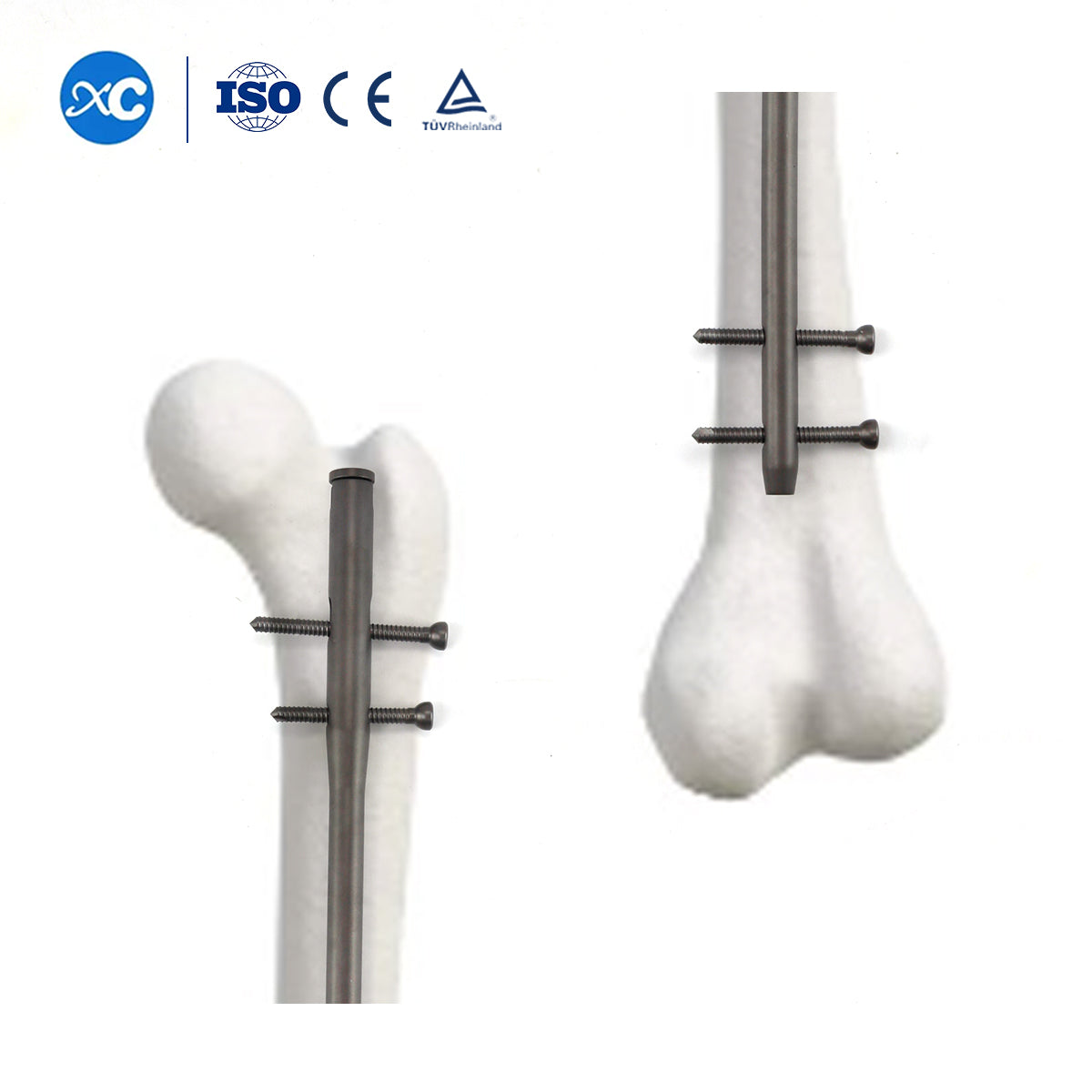 Femoral Reconstruction Intramedually Nail Match 4.5mm Locking Screw 6.5mm Locking Screw Full-threaded