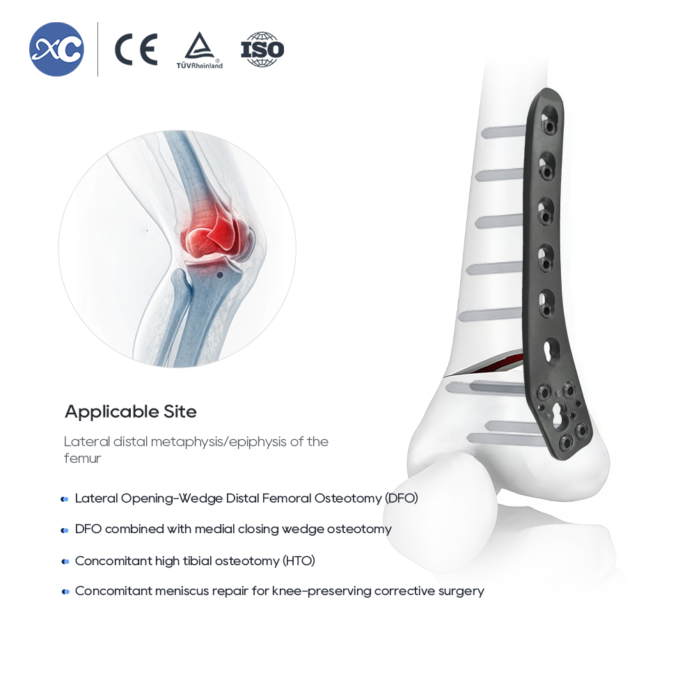 Lateral Distal Femoral WedgeOsteotomy Plate