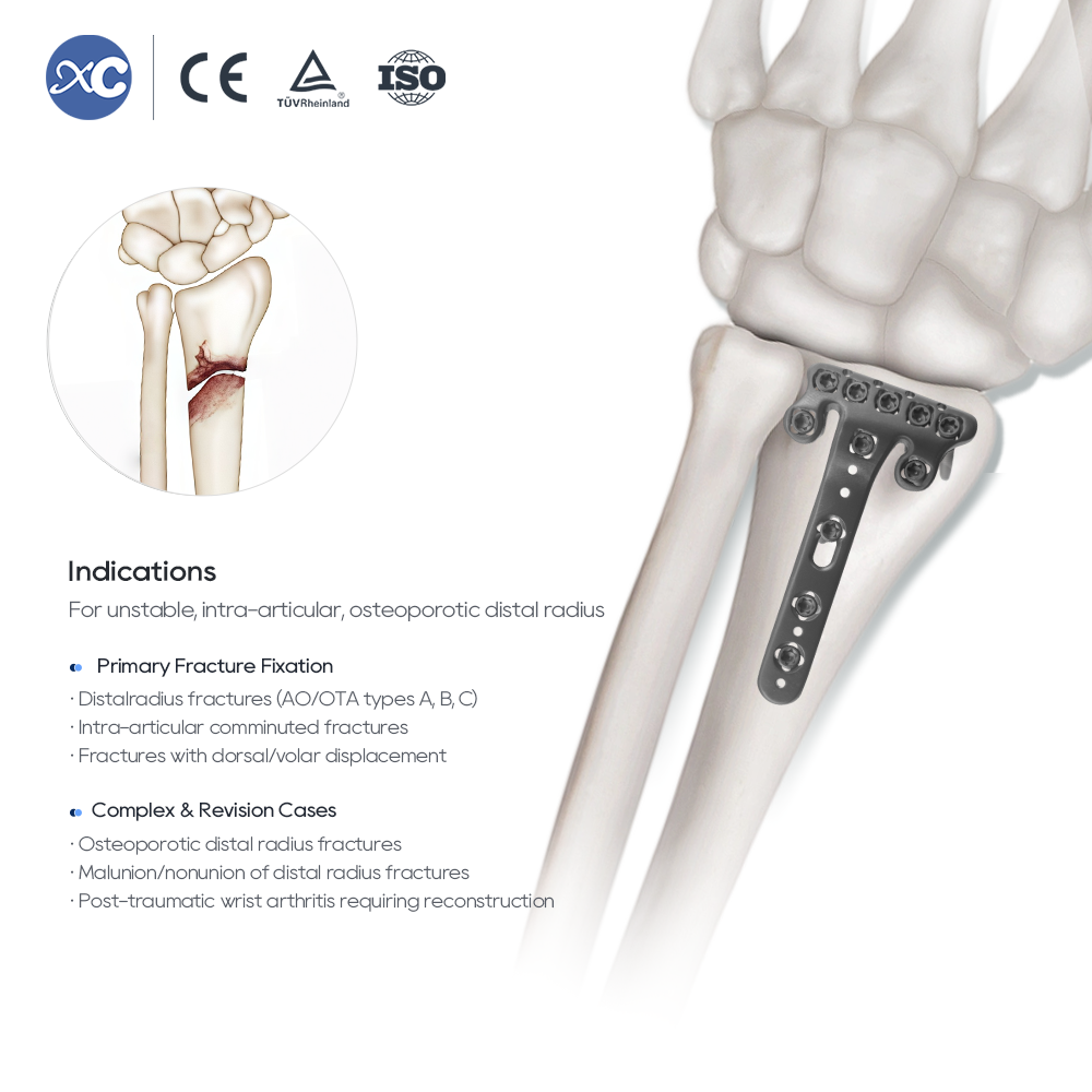 Distal Radius Volar-Multi-axial Locking Plate(withradial tap)