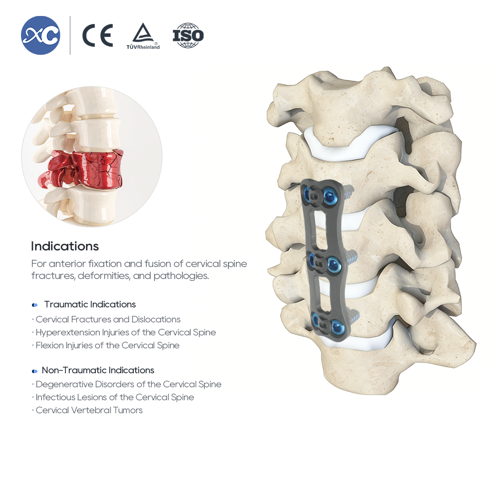 Anterior Cervical Plate-I