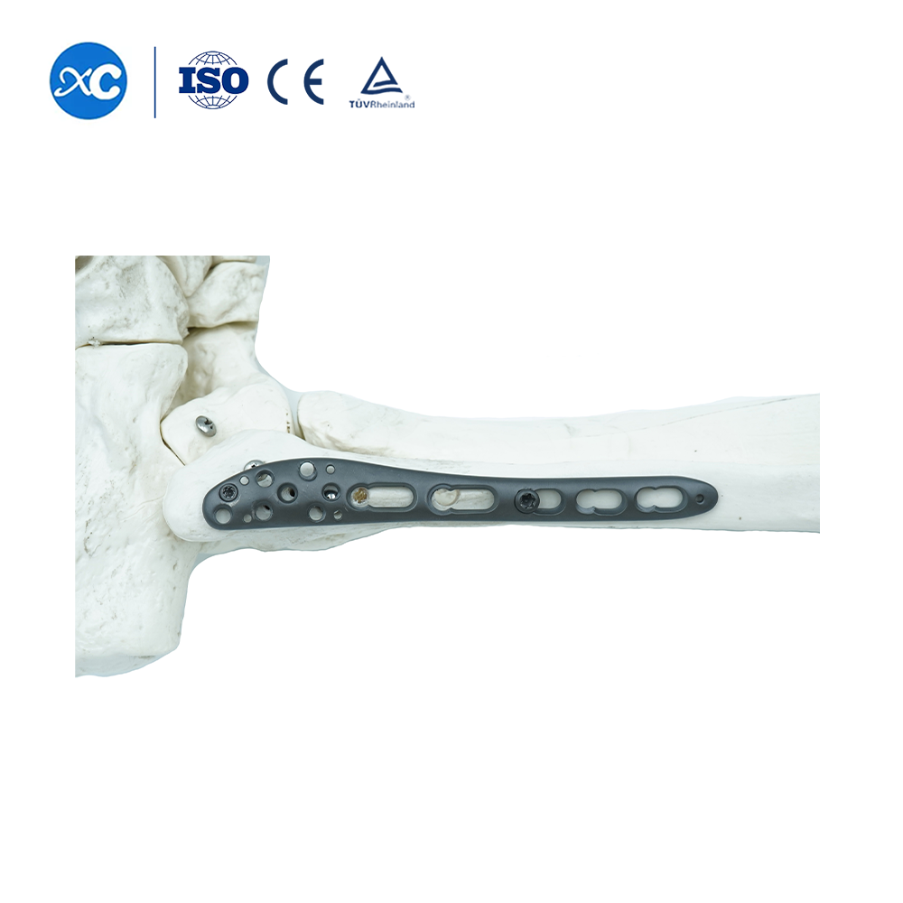 Polyaxial PlateⅠ for Tibiofibular SyndesmosisⅠ