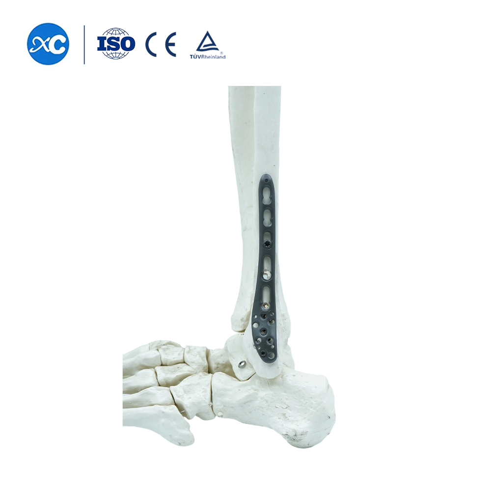 Polyaxial PlateⅠ for Tibiofibular SyndesmosisⅠ
