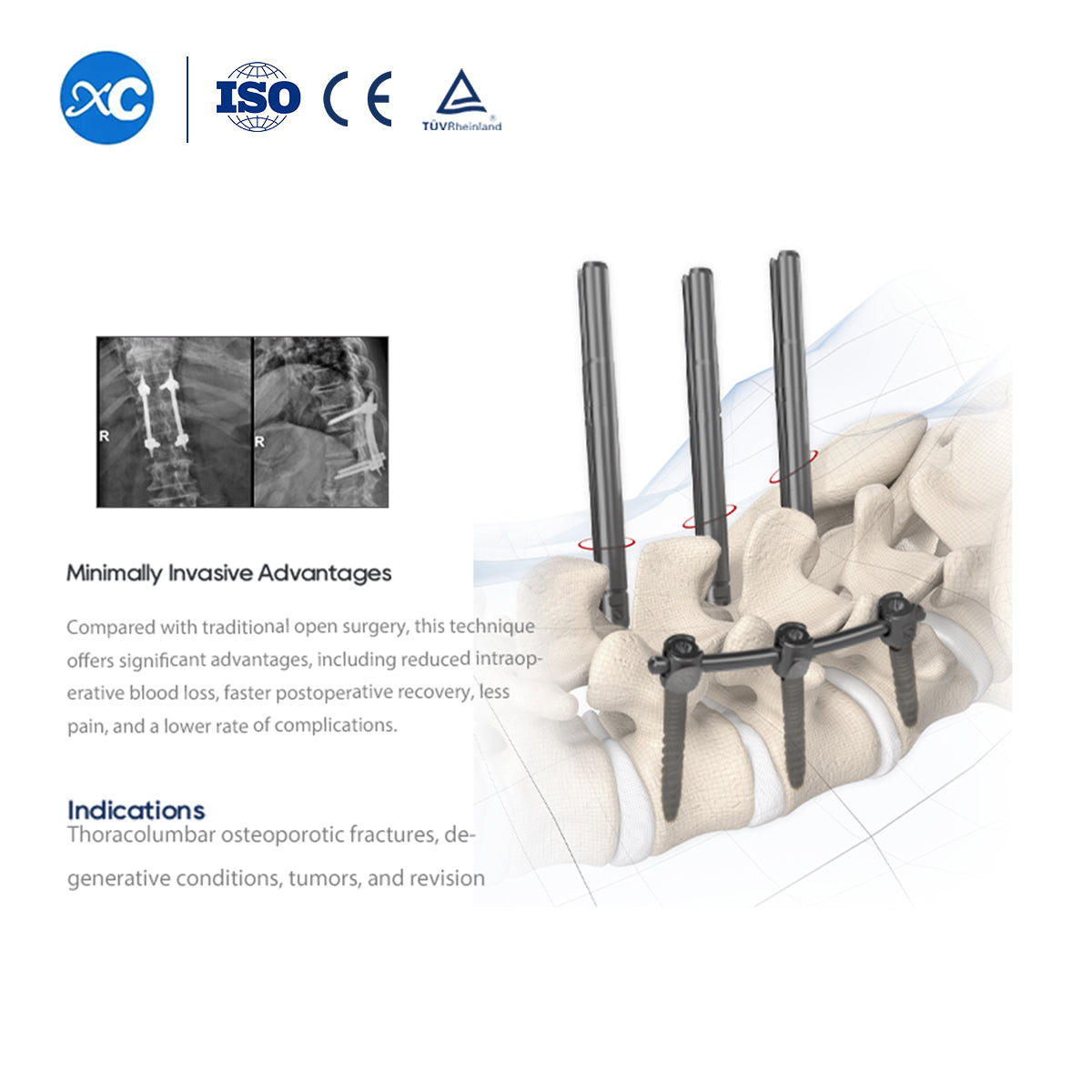 5.5 MIS Spinal System Il Pedicle Screw