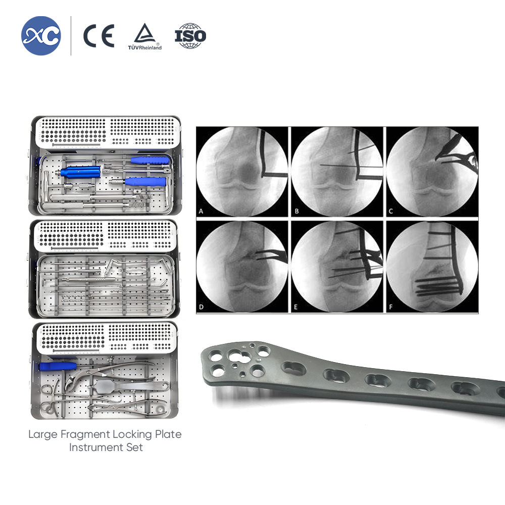 Lateral Distal Femoral WedgeOsteotomy Plate