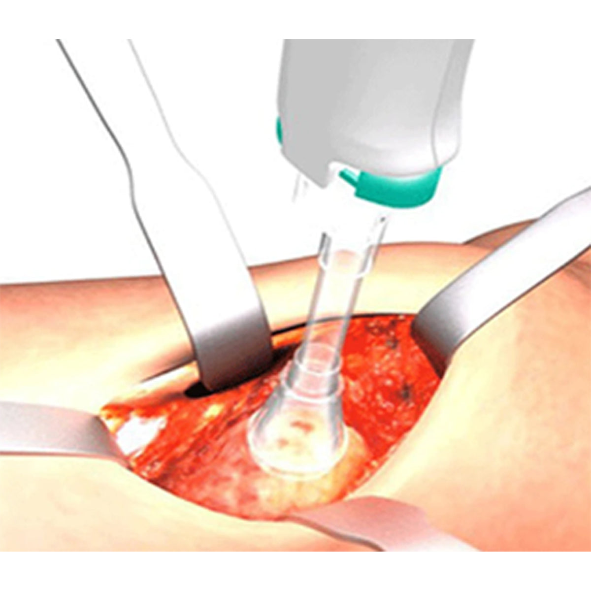 Medical Pulsed Lavage