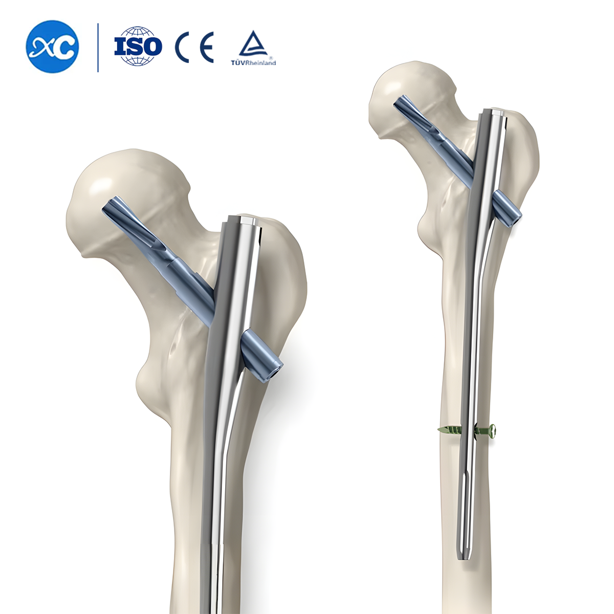 Blade Screw for PFNA(Gama) Intramedullary Nail