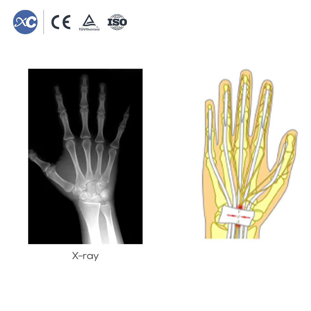 Disposable Arthroscopic Surgical Knife Auxiliary Instruments