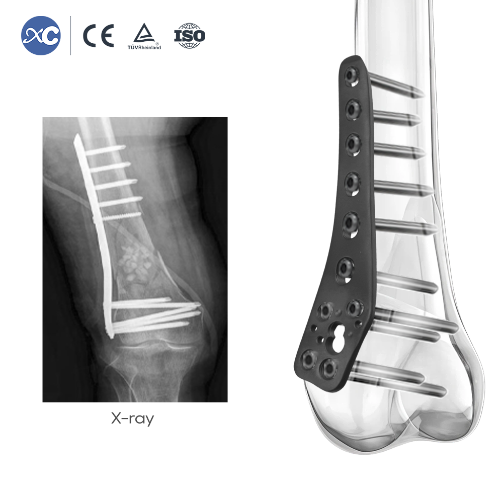 Lateral Distal Femoral WedgeOsteotomy Plate