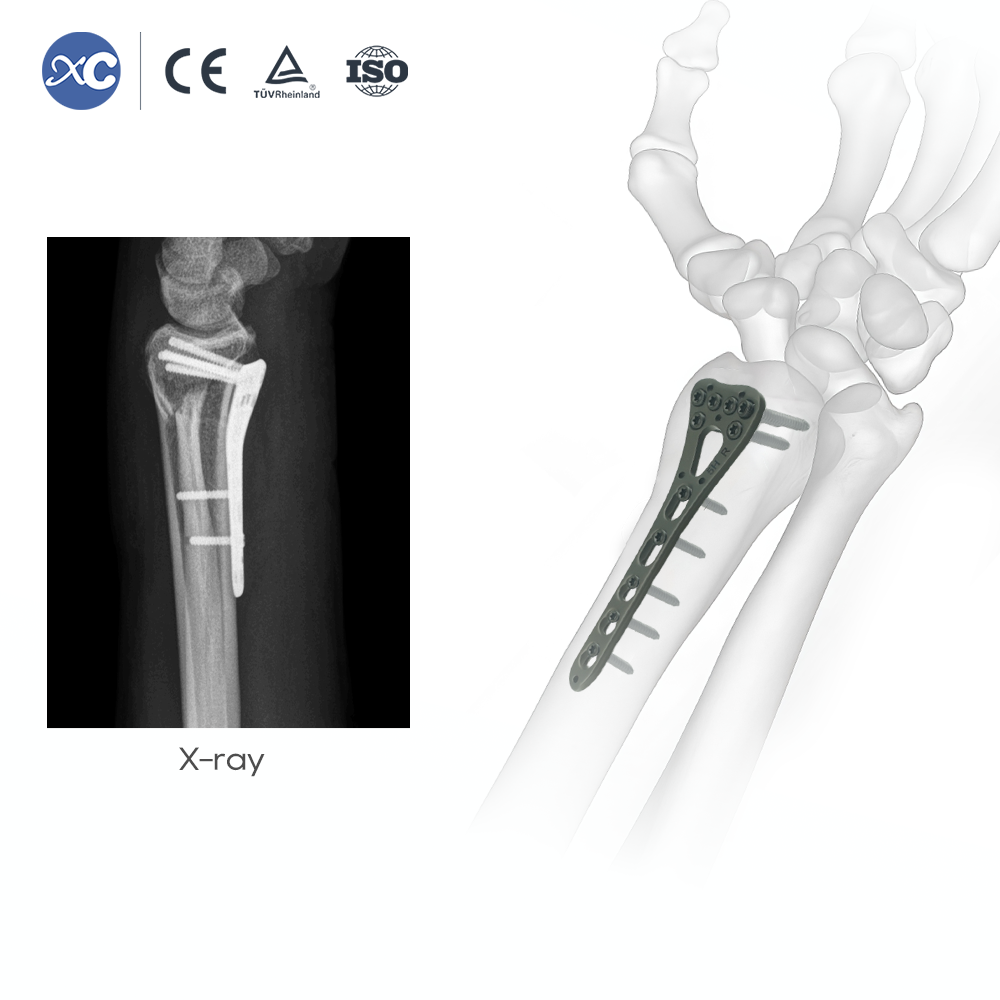 Distal Radius Instrument Set