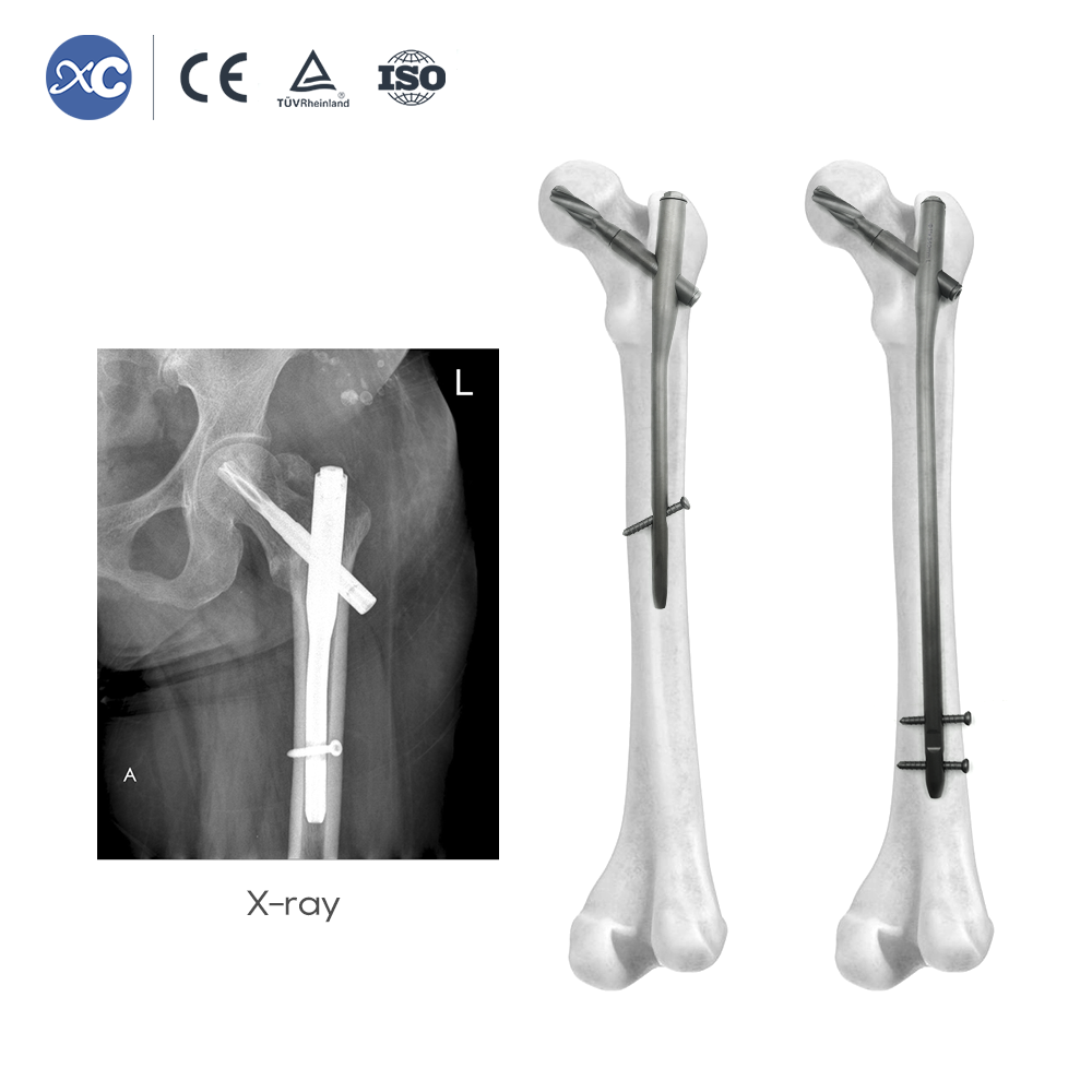 PFNA(Gama) Intramedullary Nail