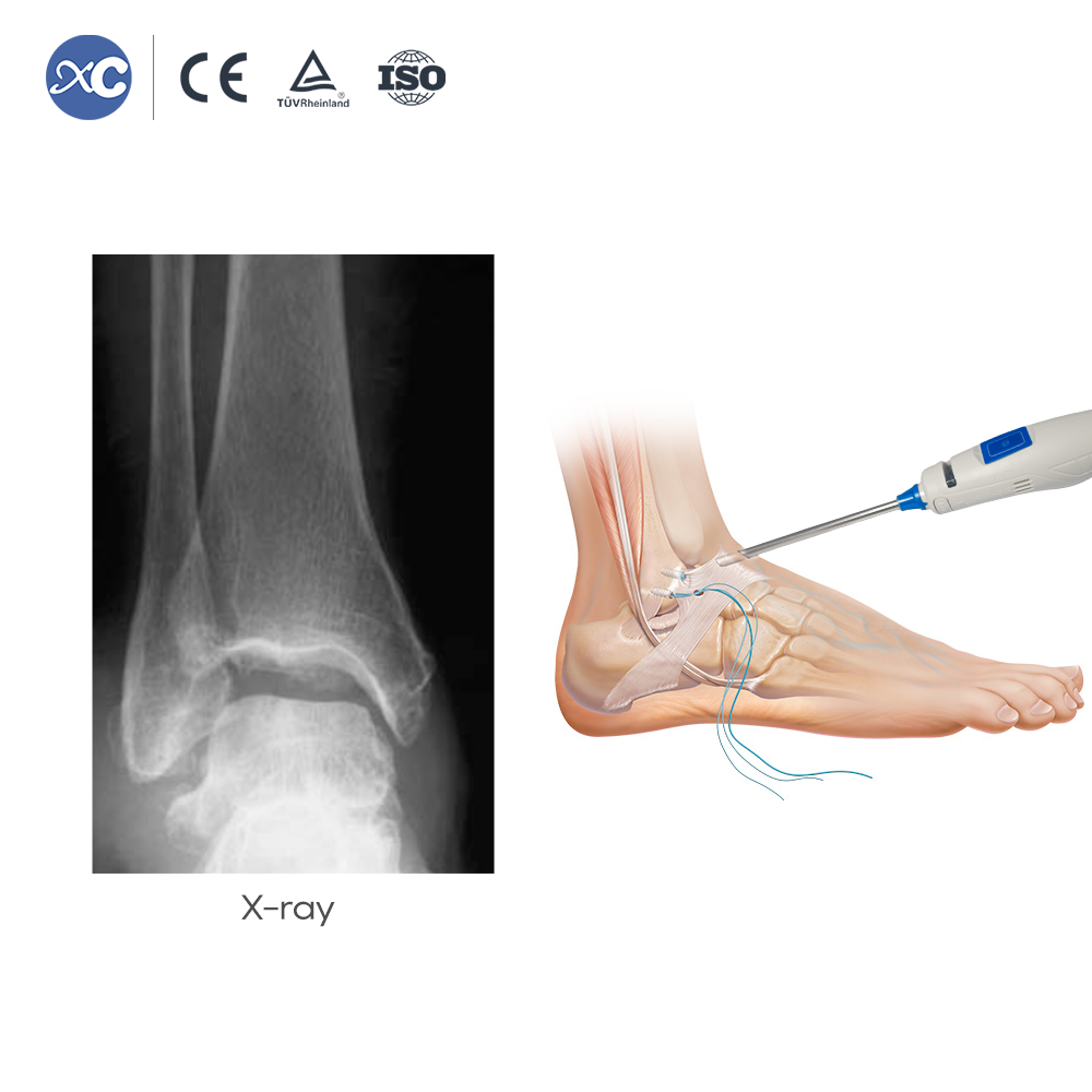 Disposable Apthroscope