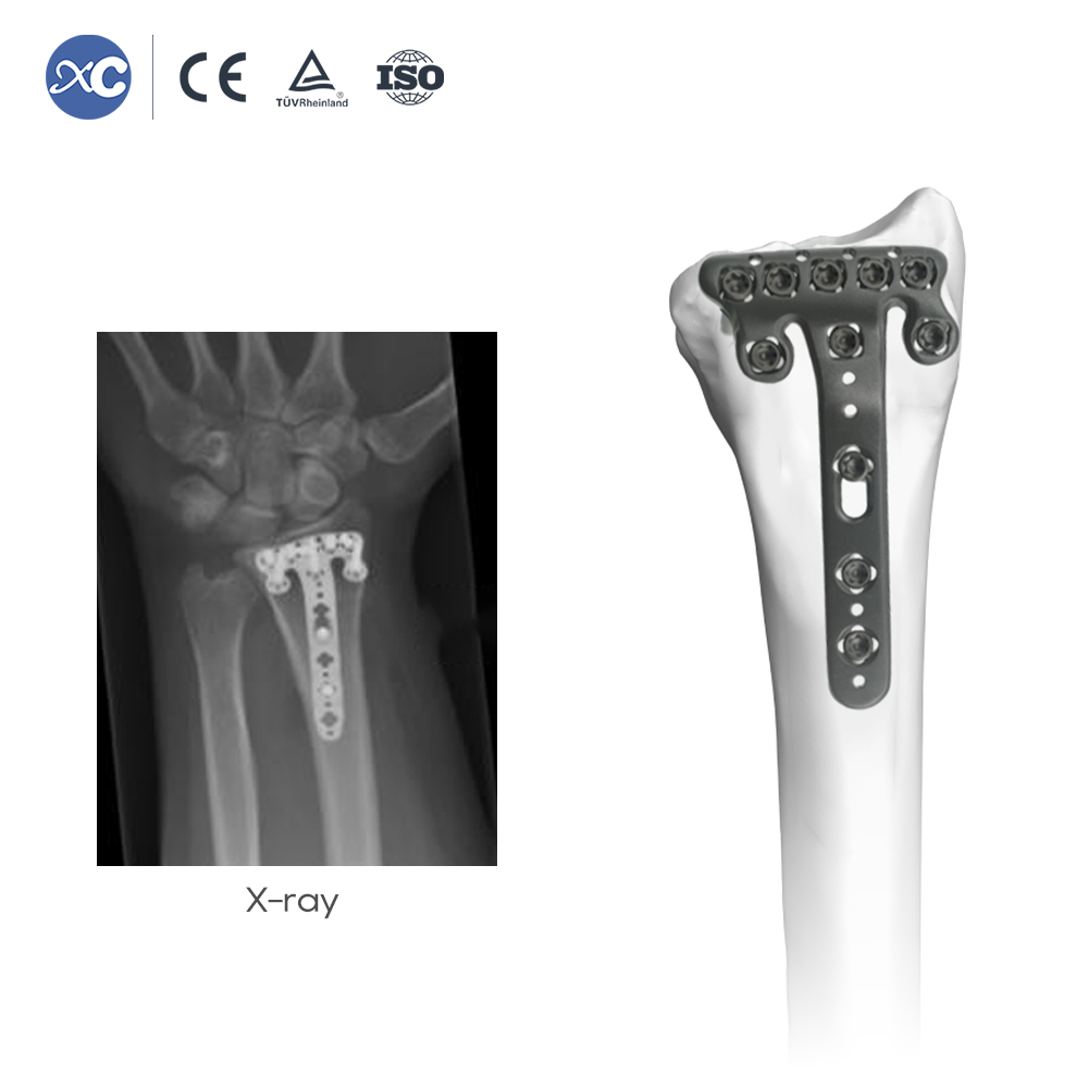 Distal Radius Volar-Multi-axial Locking Plate(withradial tap)