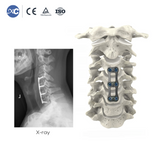 Anterior Cervical Plate-I
