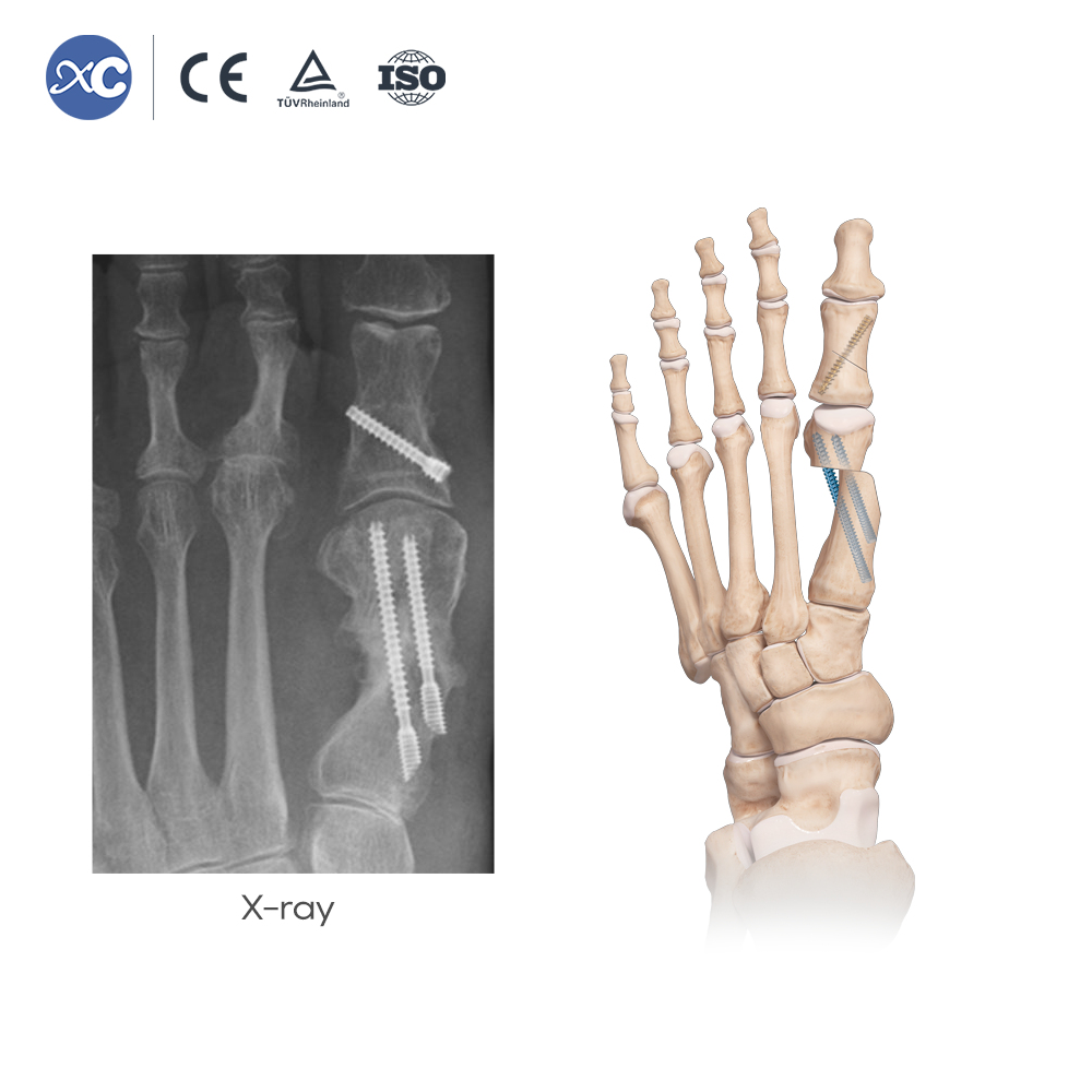 MIS Hallux Valgus Osteotomy Instrument Set