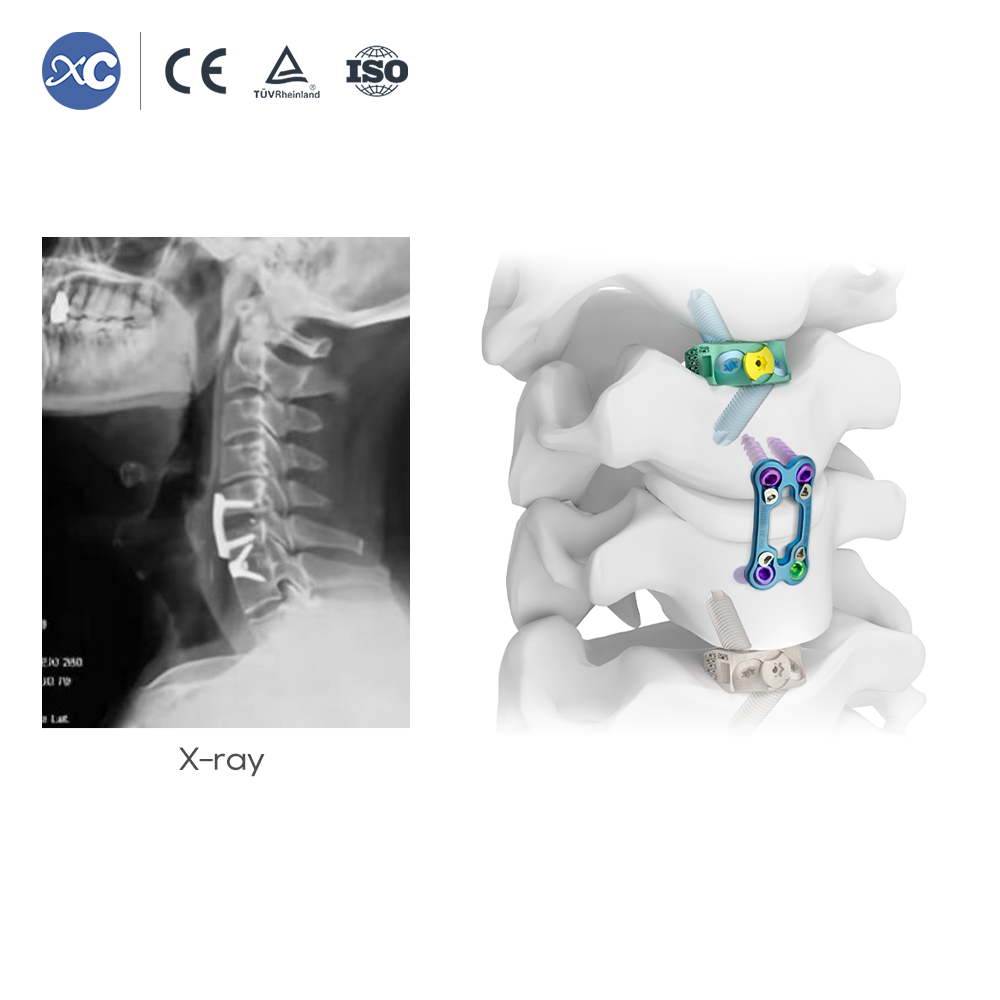 Cervical Retractor Instrument Set