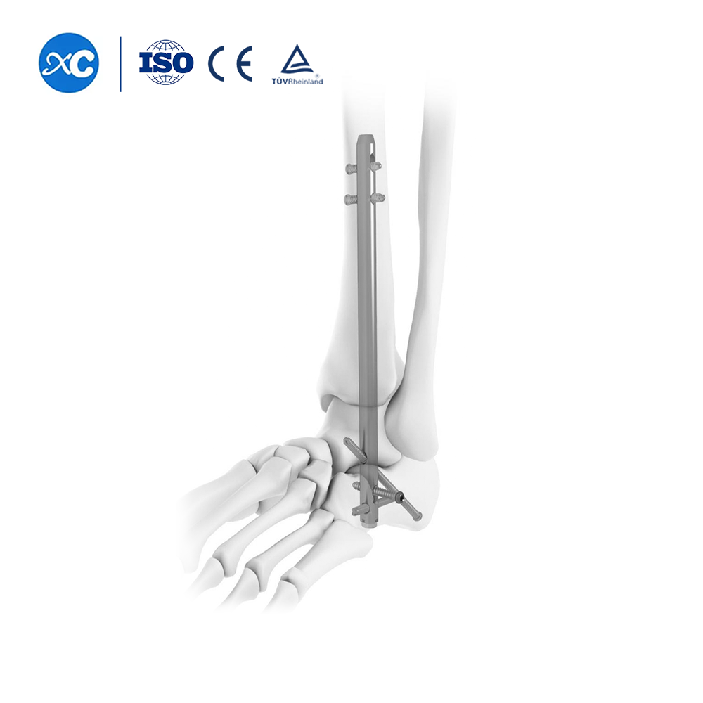 5.0mm Locking Screws for Hindfoot Fusion Ankle Nail