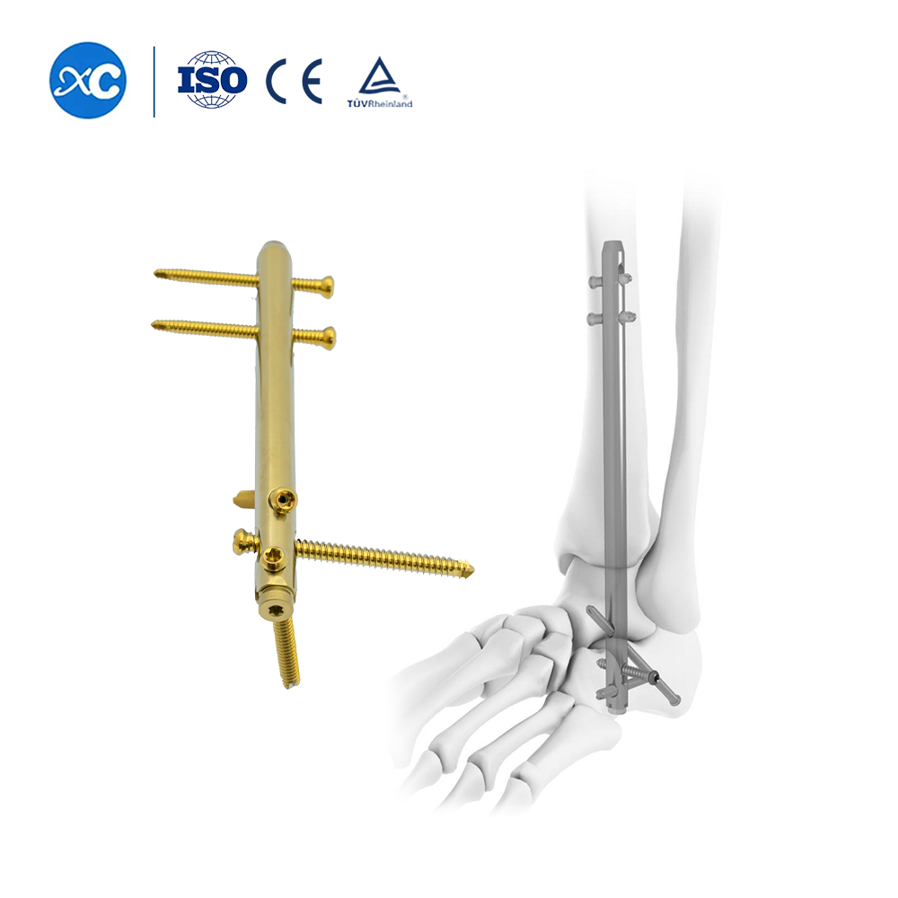 6.0mm Locking Screws for Hindfoot Fusion Ankle Nail