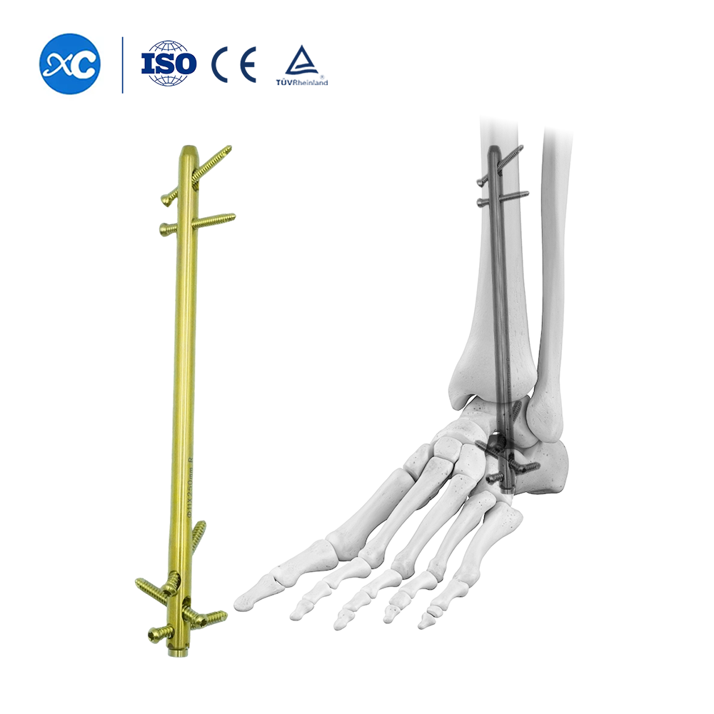 6.0mm Locking Screws for Hindfoot Fusion Ankle Nail