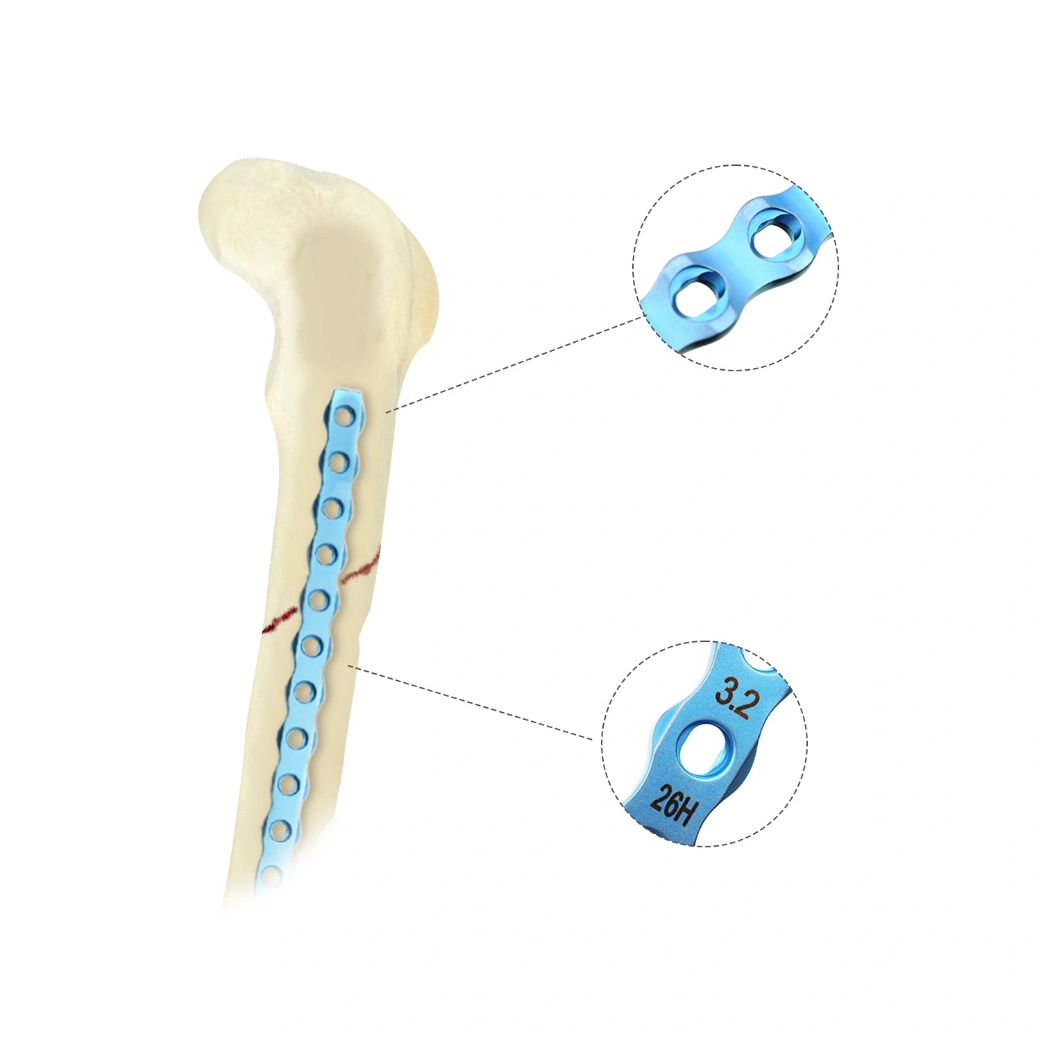 Veterinary 3.2mm ALPS-II Locking Plate for Small Animal Orthopedic Surgery