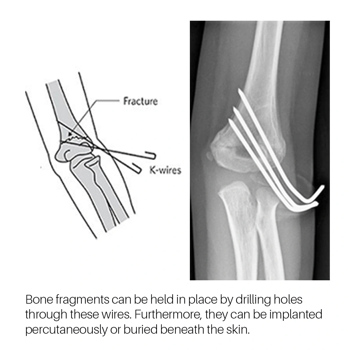 Veterinary Orthopedic Surgical Bone Instrument Stainless Steel Single Head Kirschner Wire