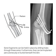 Veterinary Orthopedic Surgical Bone Instrument Stainless Steel Single Head Kirschner Wire