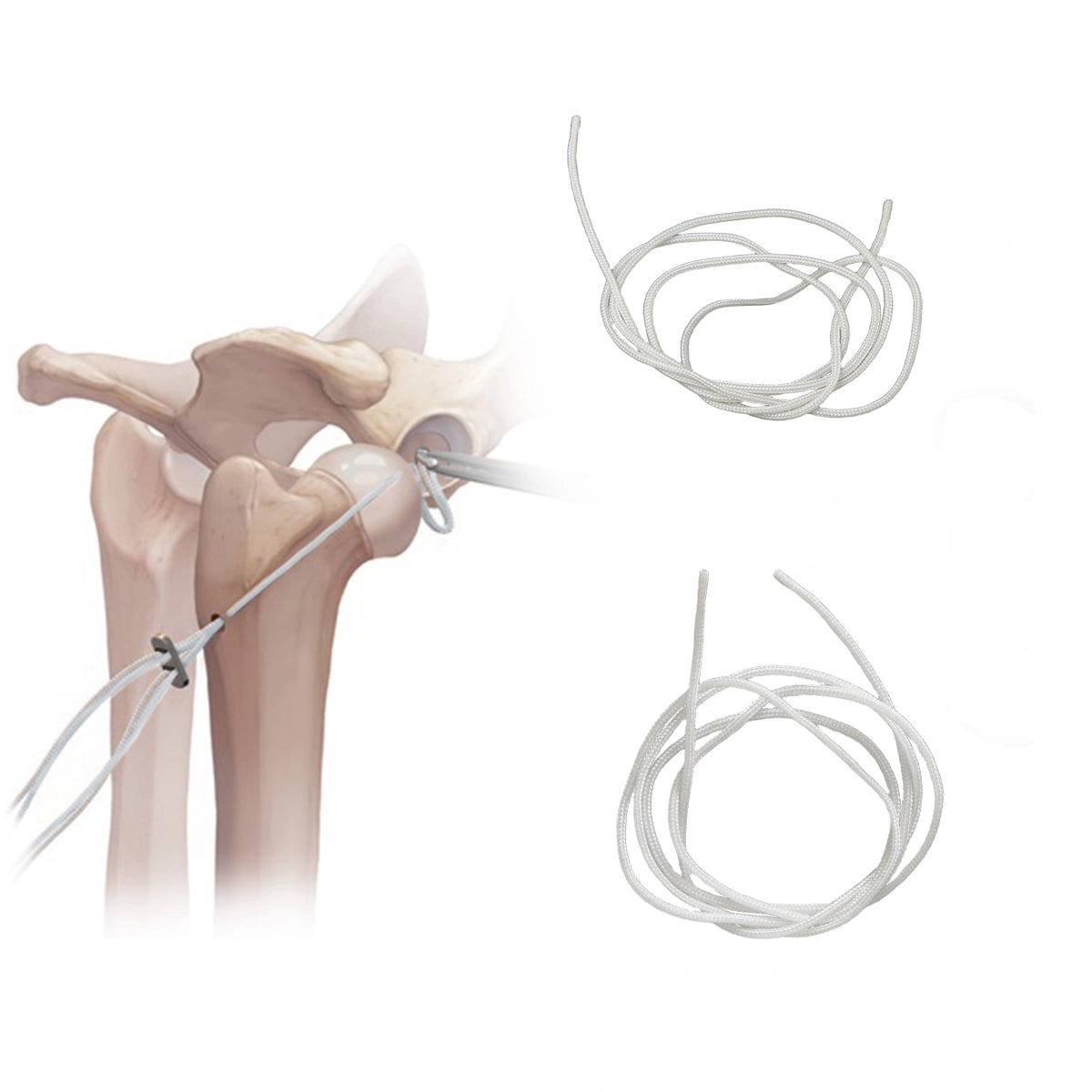 Veterinary Suture System Nylon Filament for Use with Button Suture Anchors