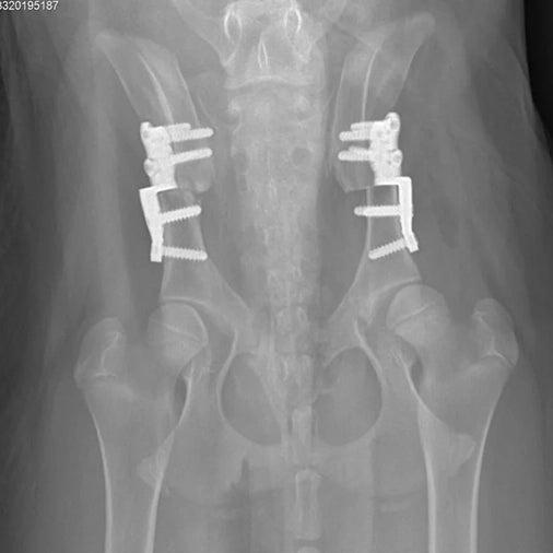 TTA System Fixation Surgery