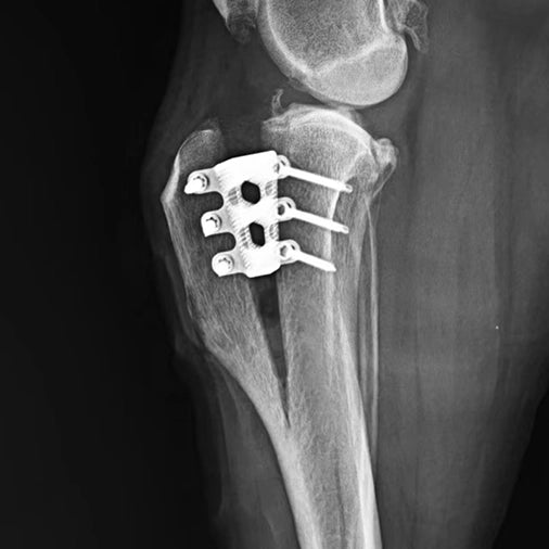 TTA System Fixation Surgery