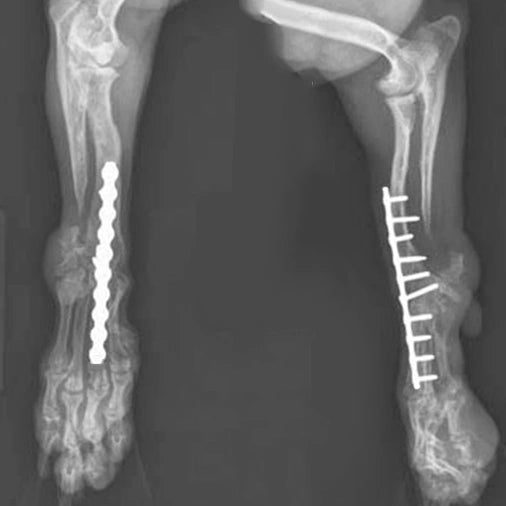 Radius Fracture Fixation（Locking Plate)