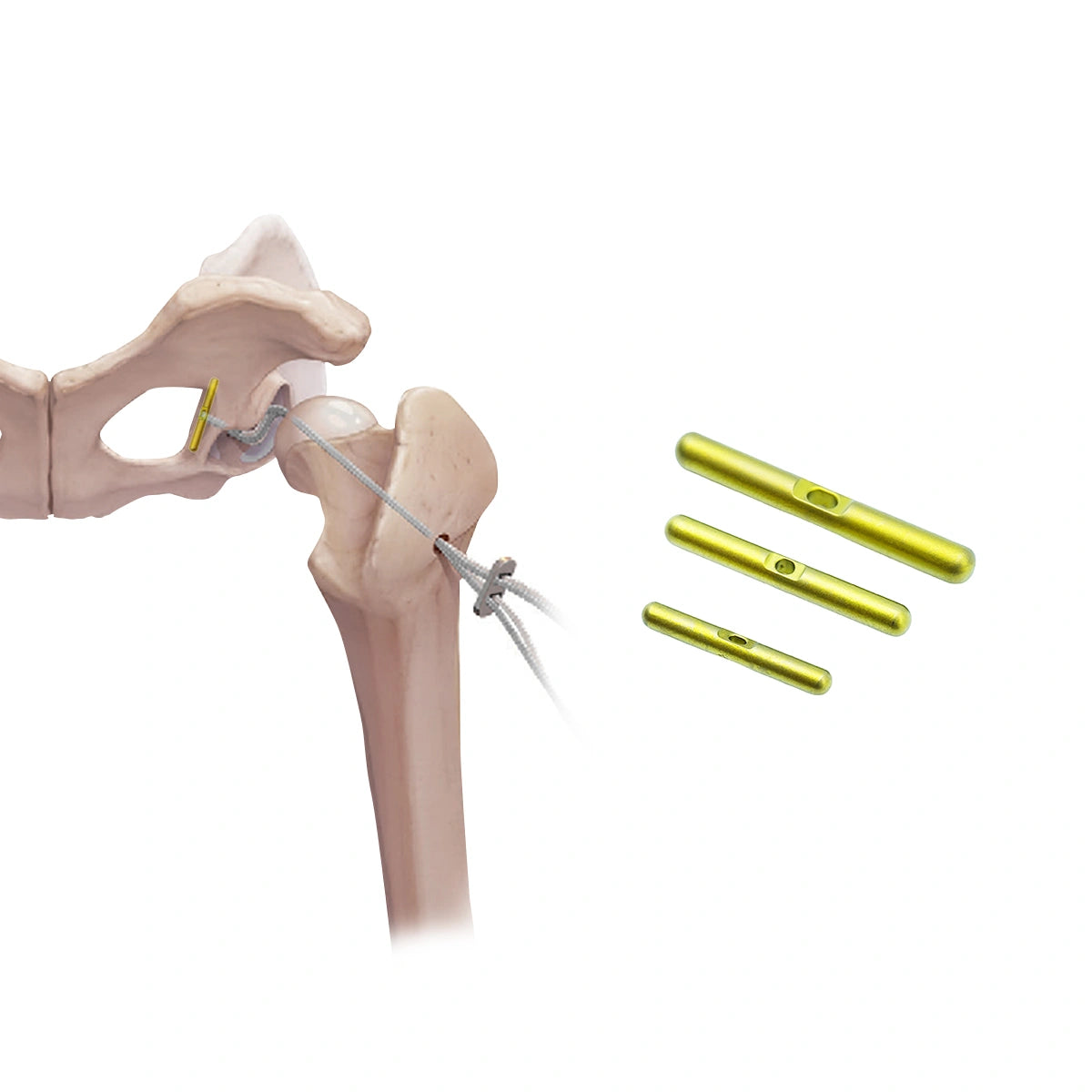 Joint Bone Button for Animal Orthopedic & Sports Medicine Surgery