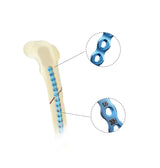 Veterinary Orthopedics ALPS-II 1.6mm Reliable Fracture Plate System - xcvet.com