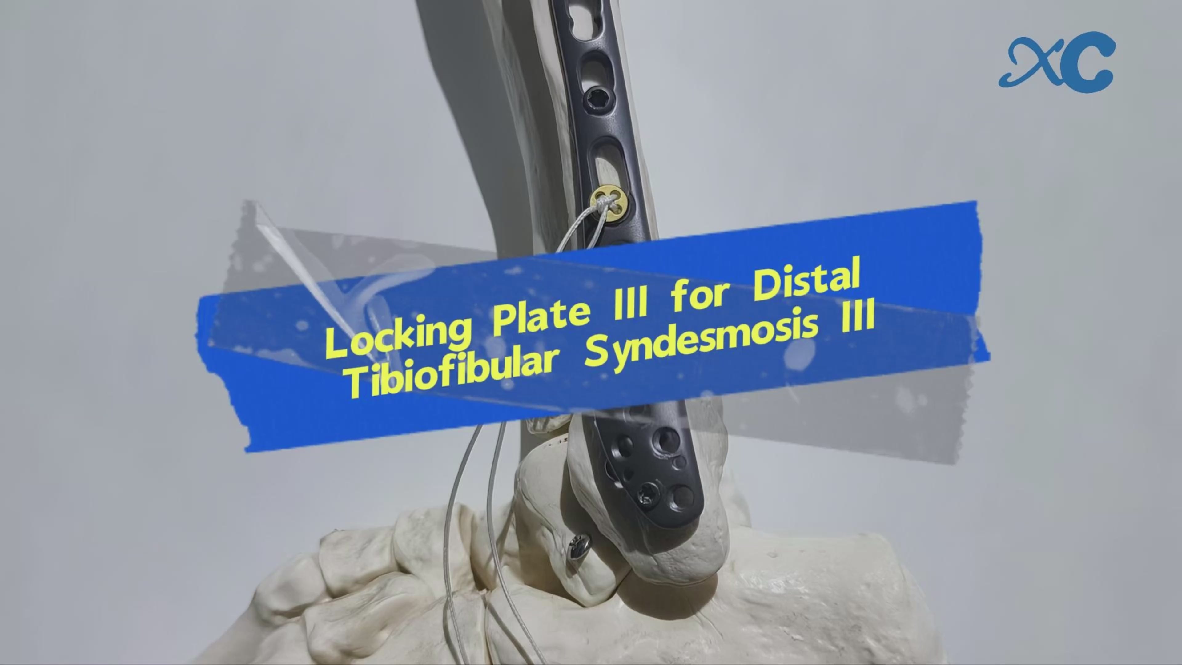 Load video: Locking Plate III for Distal Tibiofibular Syndesmosis Ⅲ