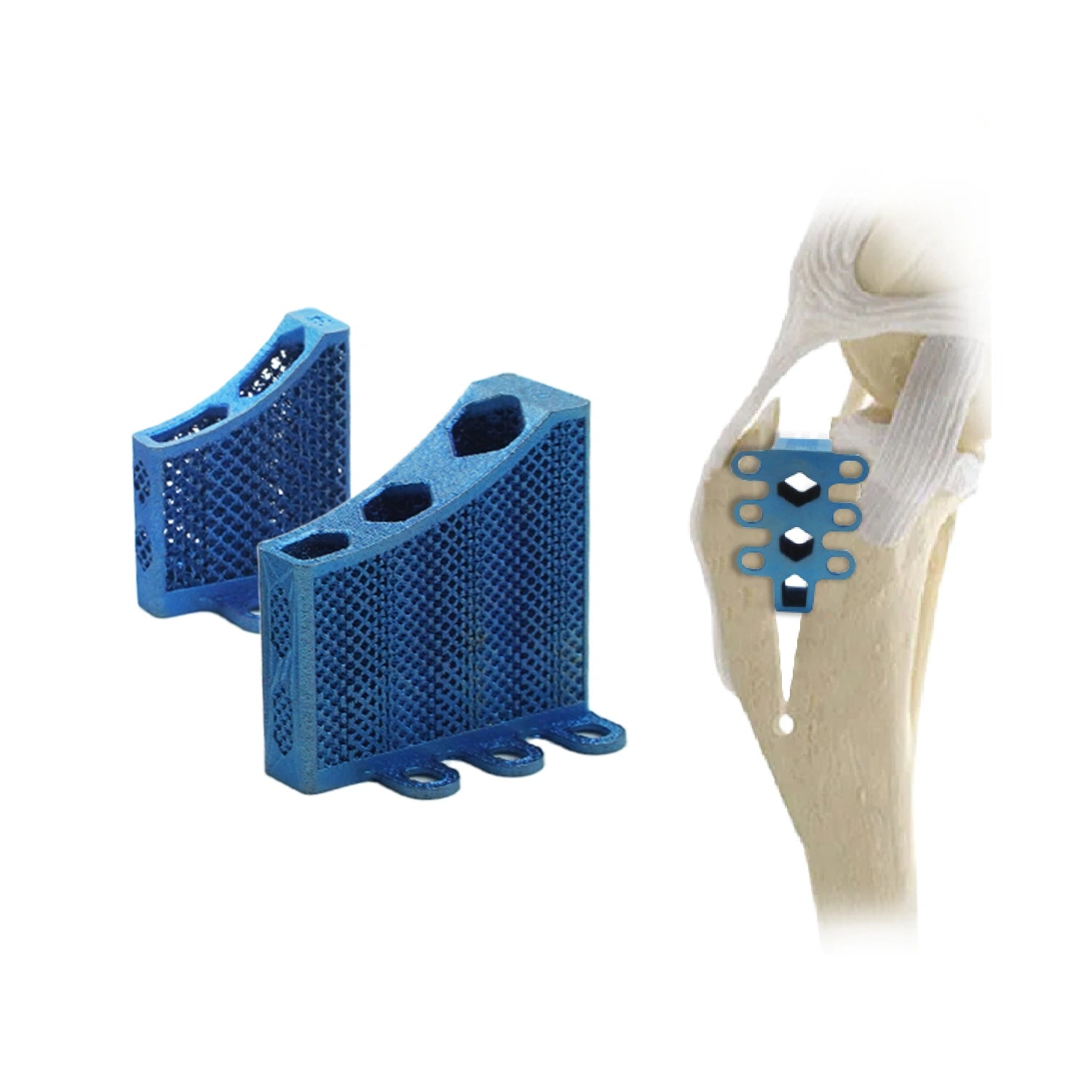 Locking TTA Orthopedic Veterinary Titanium 3D Printed Rapid Cage Implant - xcvet.com